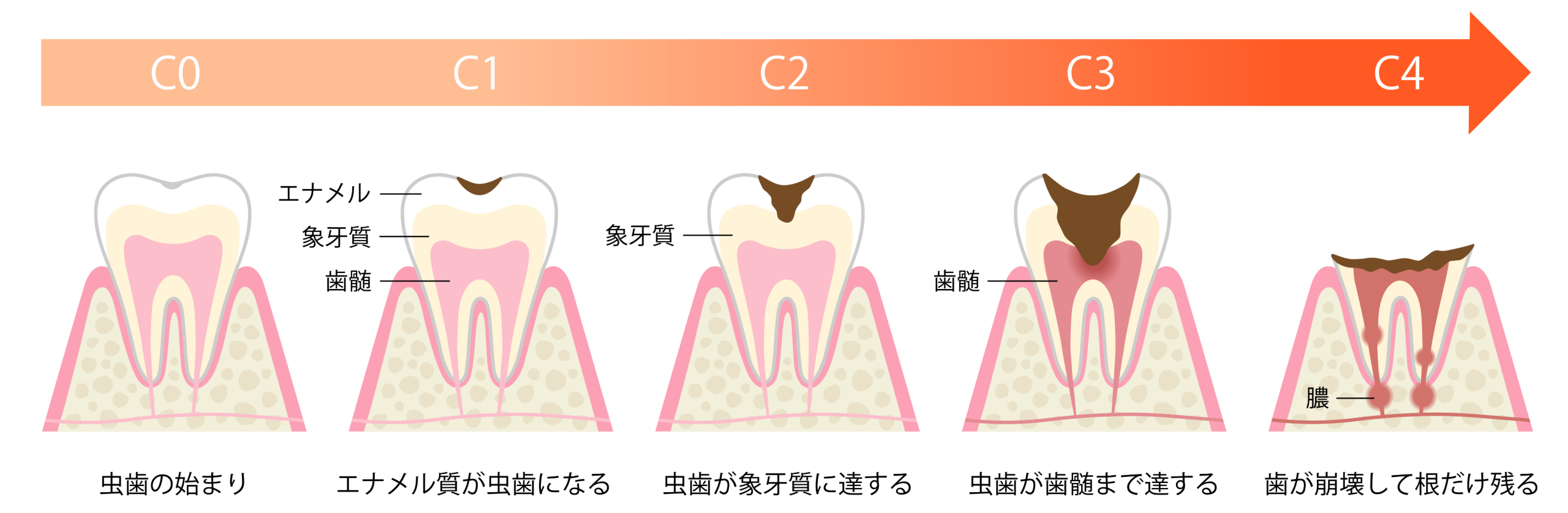 虫歯の進行段階 C0からC4までの図解