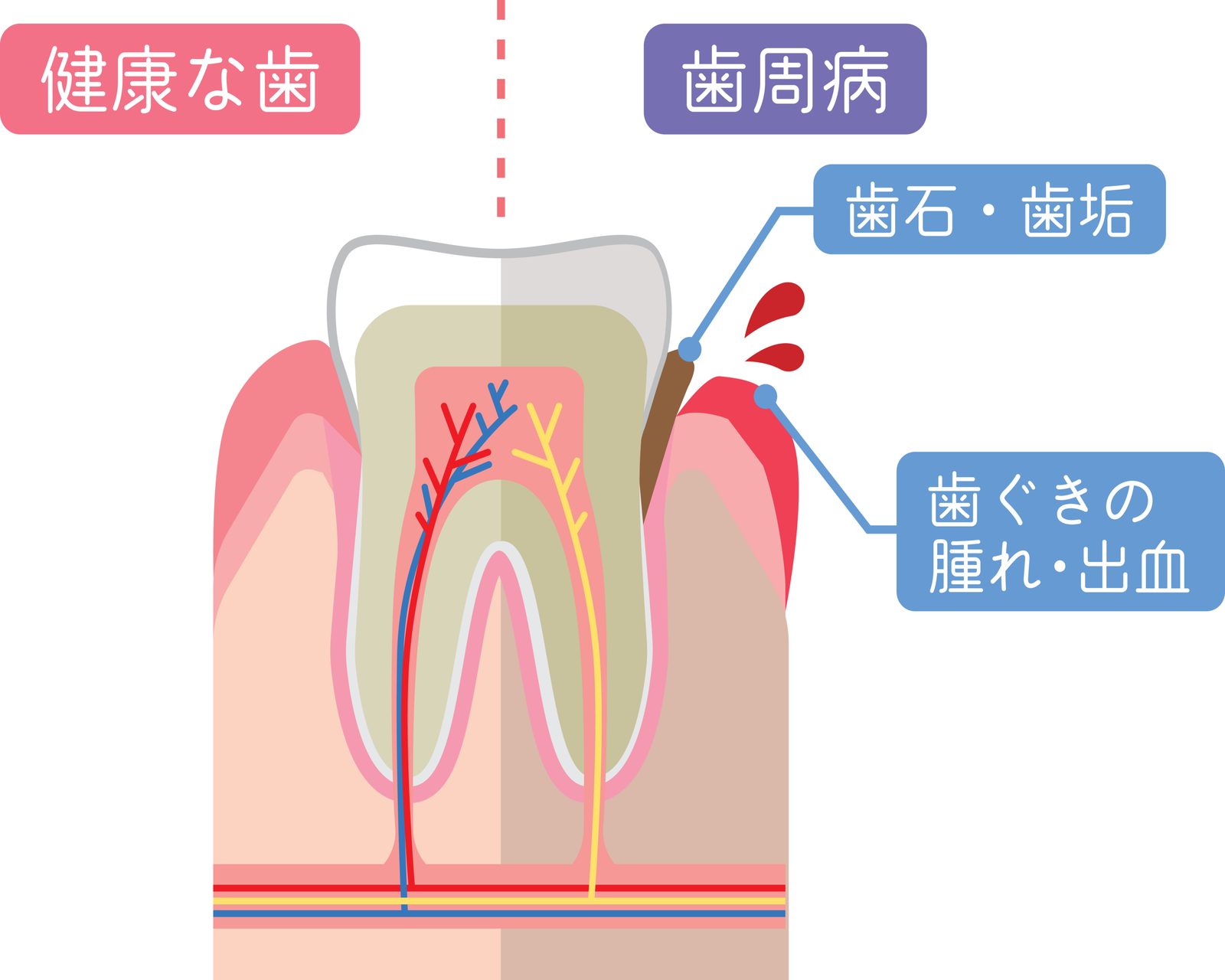 歯周病の説明用模型