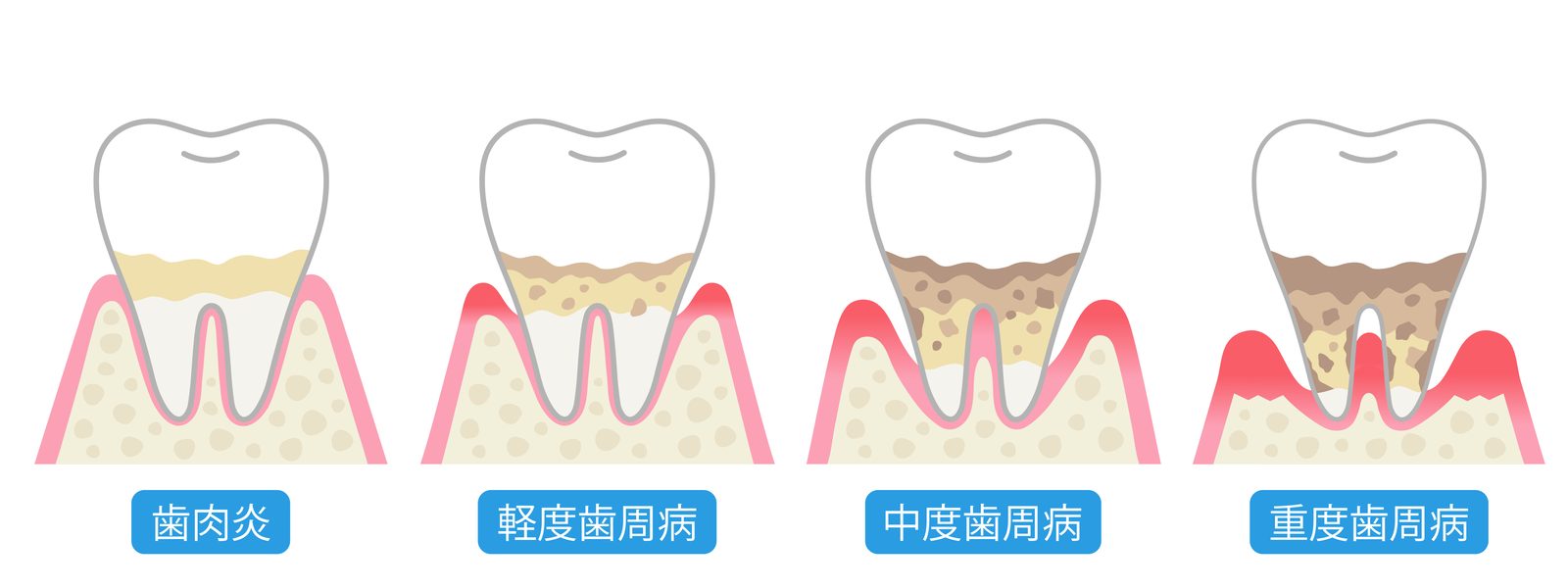 歯周病の進行段階を示すイメージ