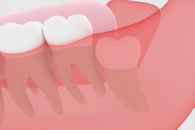 親知らず（第三大臼歯）のイメージ